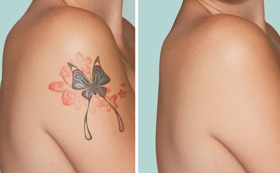 Hire Expert Tattoo Removal Services to Remove the Tattoo Safely
