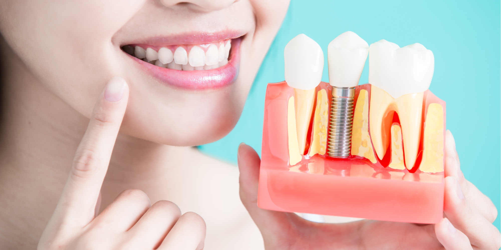 5 Benefits of Tooth Implants You Need to Know