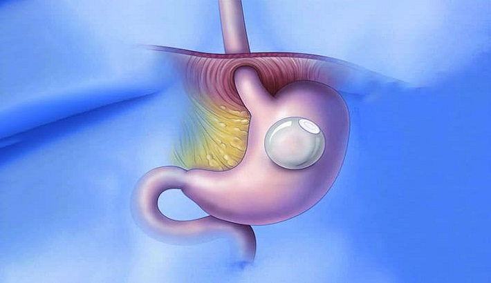 How To Choose The Right Surgeon For Gastric Band Surgery?