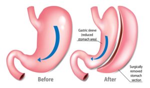 gastric band surgery Melbourne